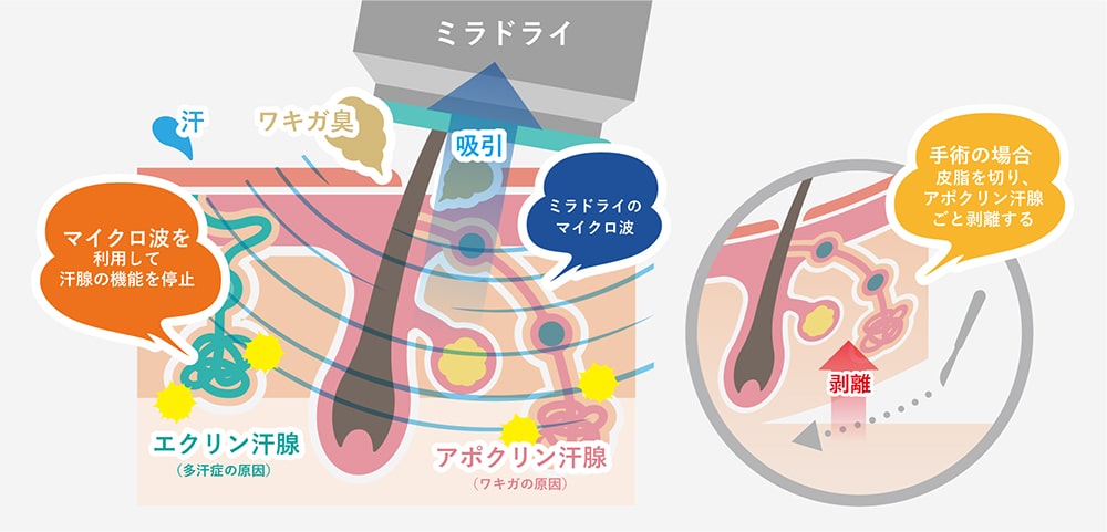 ミラドライ